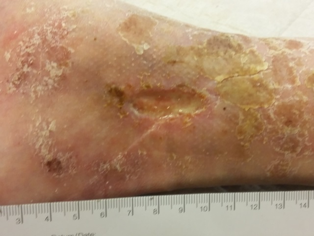 Ulcus cruris venosum